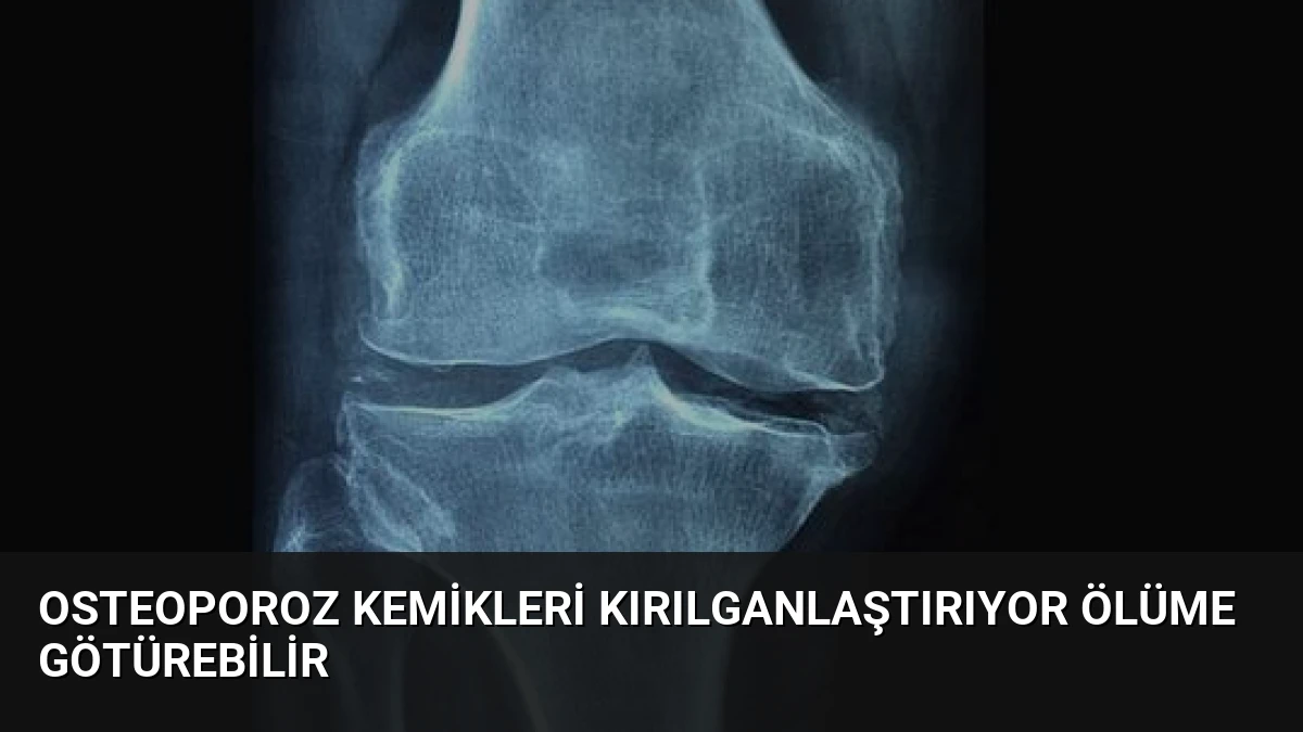 Osteoporoz Kemikleri Kırılganlaştırıyor Ölüme Götürebilir