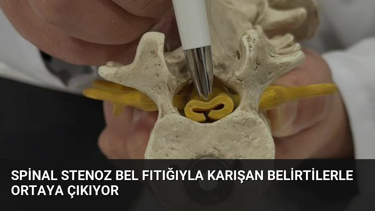 Spinal Stenoz Bel Fıtığıyla Karışan Belirtilerle Ortaya Çıkıyor