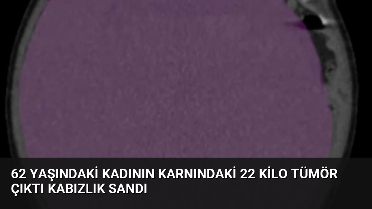 62 Yaşındaki Kadının Karnındaki 22 Kilo Tümör Çıktı Kabızlık Sandı