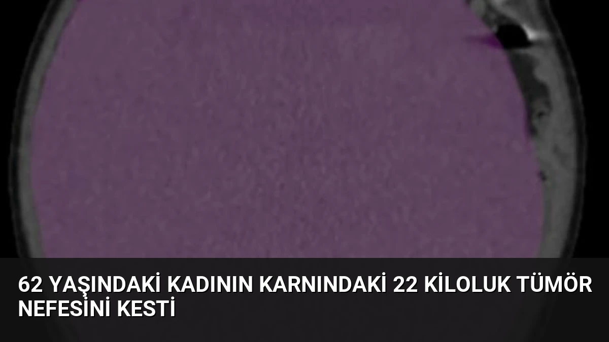 62 Yaşındaki Kadının Karnındaki 22 Kiloluk Tümör Nefesini Kesti