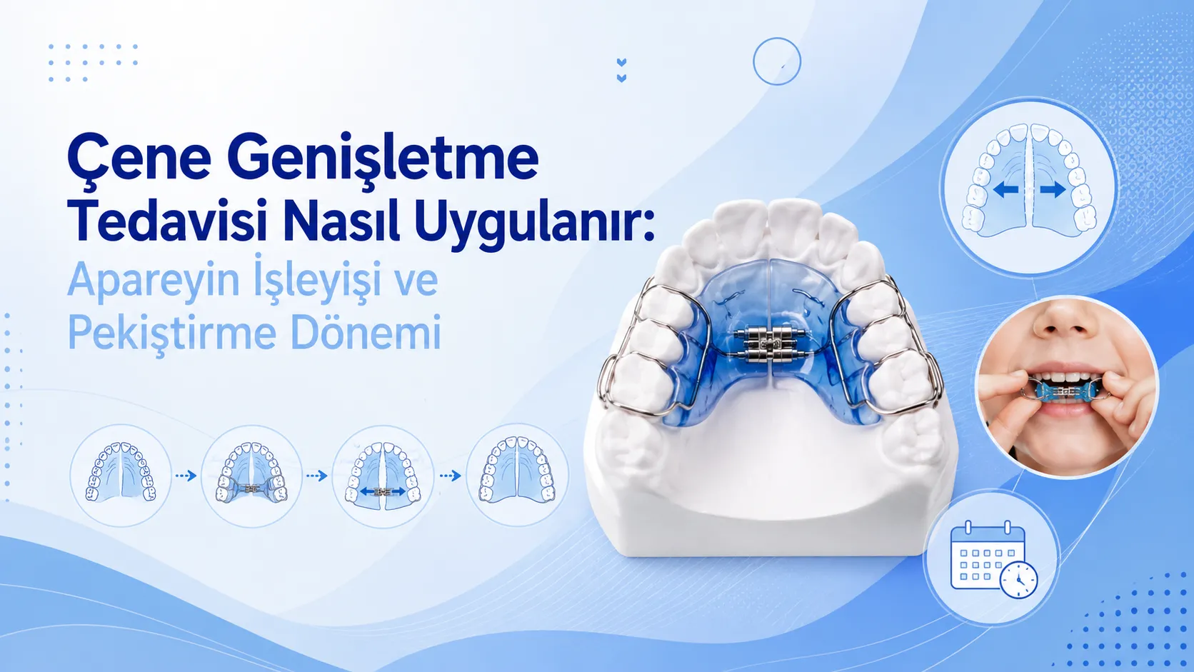 Çene Genişletme Tedavisi Nasıl Uygulanır: Apareyin İşleyişi ve Pekiştirme Dönemi